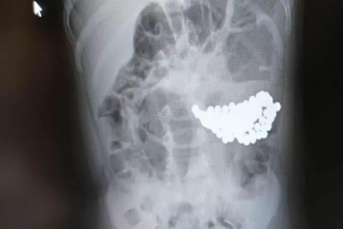 Врач Кожин назвал игрушки, из-за которых дети попадают к хирургам