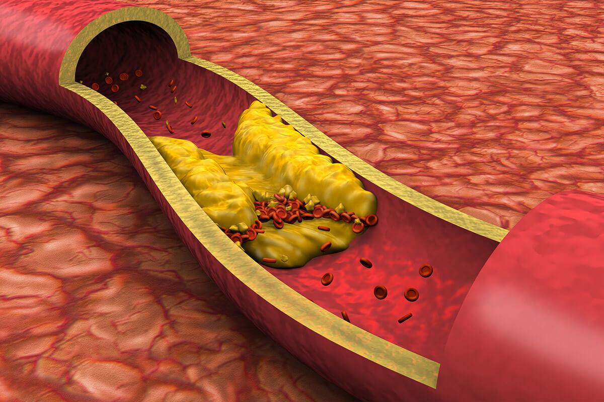 Ученые выяснили, как бездействие организма влияет на уровень холестерина