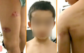 7-летний мальчик лишился восьми пальцев рук после истязательств отца