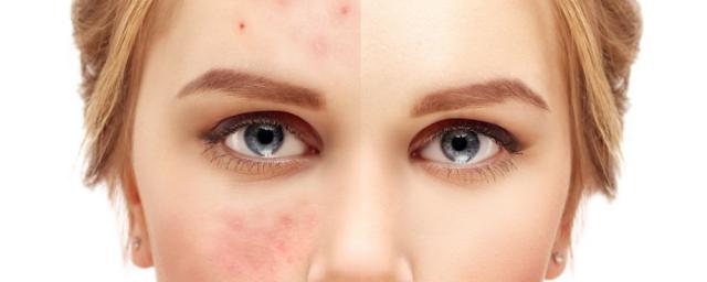 Дерматолог рассказал, какие кожные заболевания провоцирует коронавирус