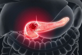 Scientists from the UK and the US have moved closer to curing pancreatic cancer