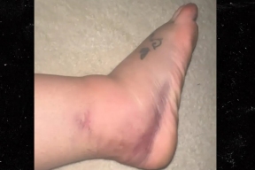 Певица Бритни Спирс показала, как ее нога распухла через 2 недели после перелома