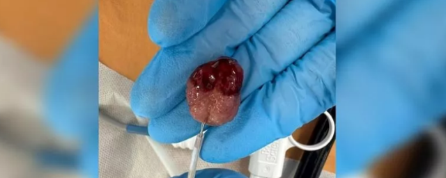 В Новороссийске врачи впервые удалили опухоль в кишечнике ребенка, не прибегая к разрезам