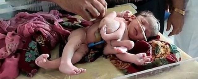 В Индии на свет появился ребенок с четырьмя ногами и тремя руками