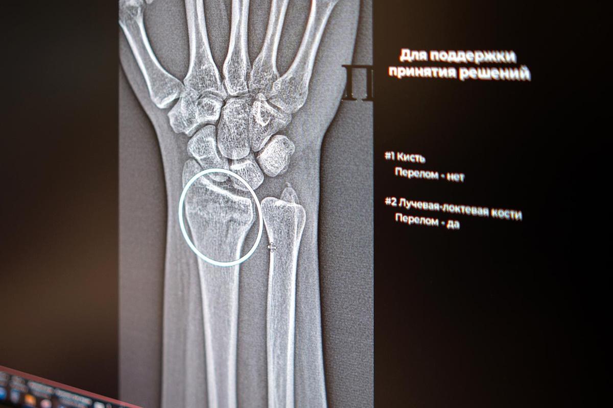 Клиническая медицина Москвы пополнится новыми ИИ-сервисами для диагностики травм костей