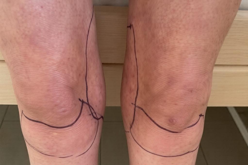 Жительнице Краснодарского края грозит ампутация ног после бьюти-процедуры