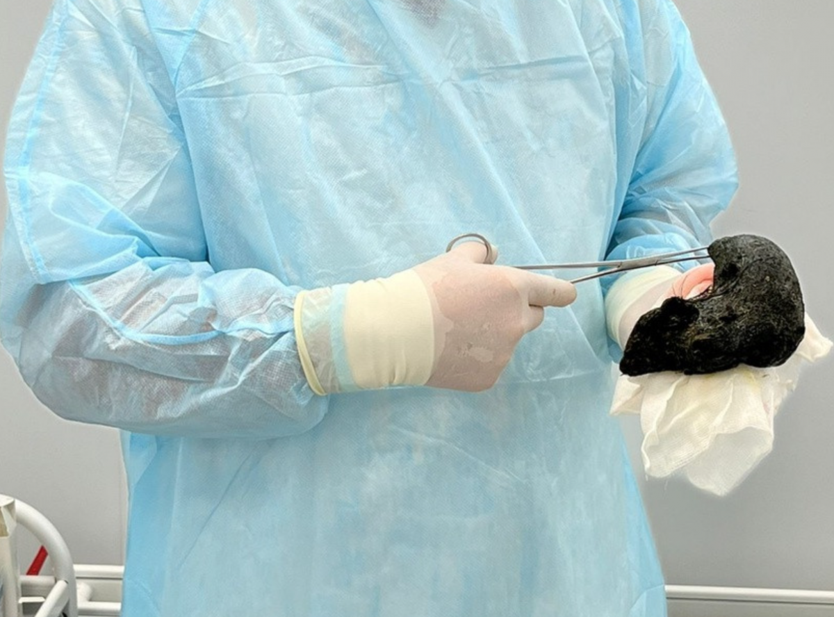 В Кирове хирурги вынули из желудков детей инородные предметы