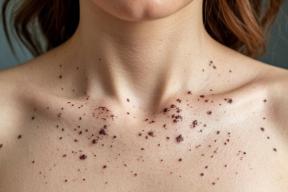 Опасность под кожей: нужно ли наблюдаться у врача, если папилломы были удалены?