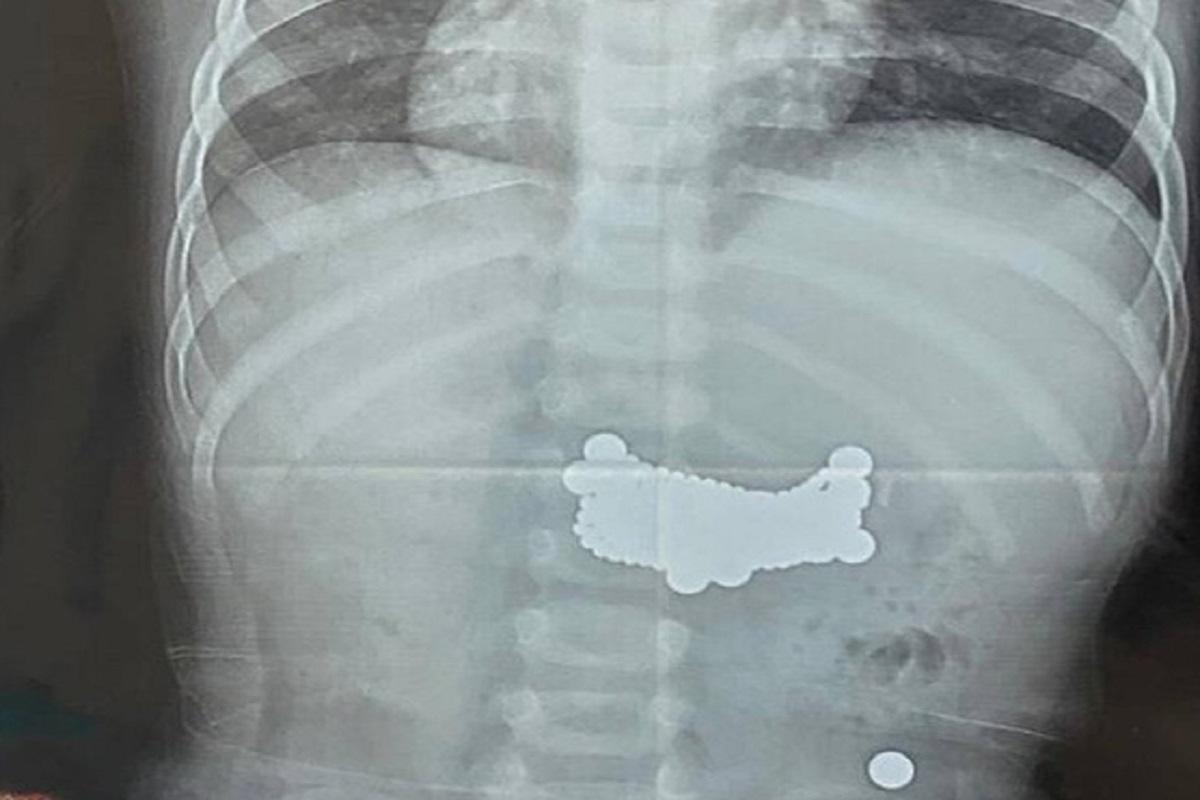 Перфорация желудка и две операции: школьник проглотил 11 магнитов