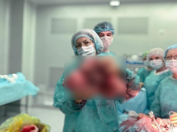В Томске в онкодиспансере женщине удалили огромную опухоль