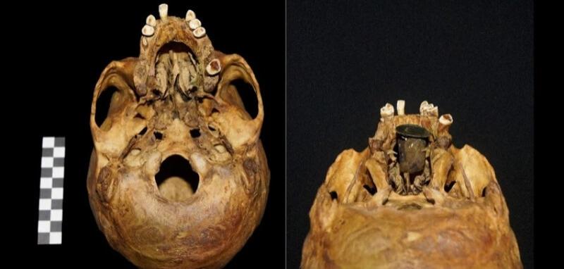 В черепе мужчины, захороненного в склепе, польские ученые нашли 300-летний протез для расщепленного нёба