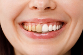 Dentist explains why teeth get darker