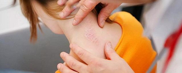 Калифорнийские ученые объяснили, почему кожа на разных частях тела подвержена разным заболеваниям