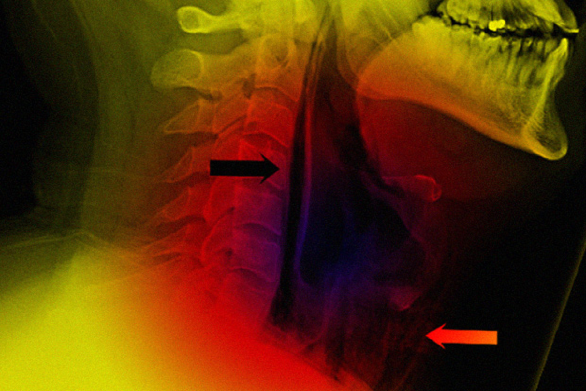 Врачи из Карелии предупредили, чем грозит попытка «заглушить» чих