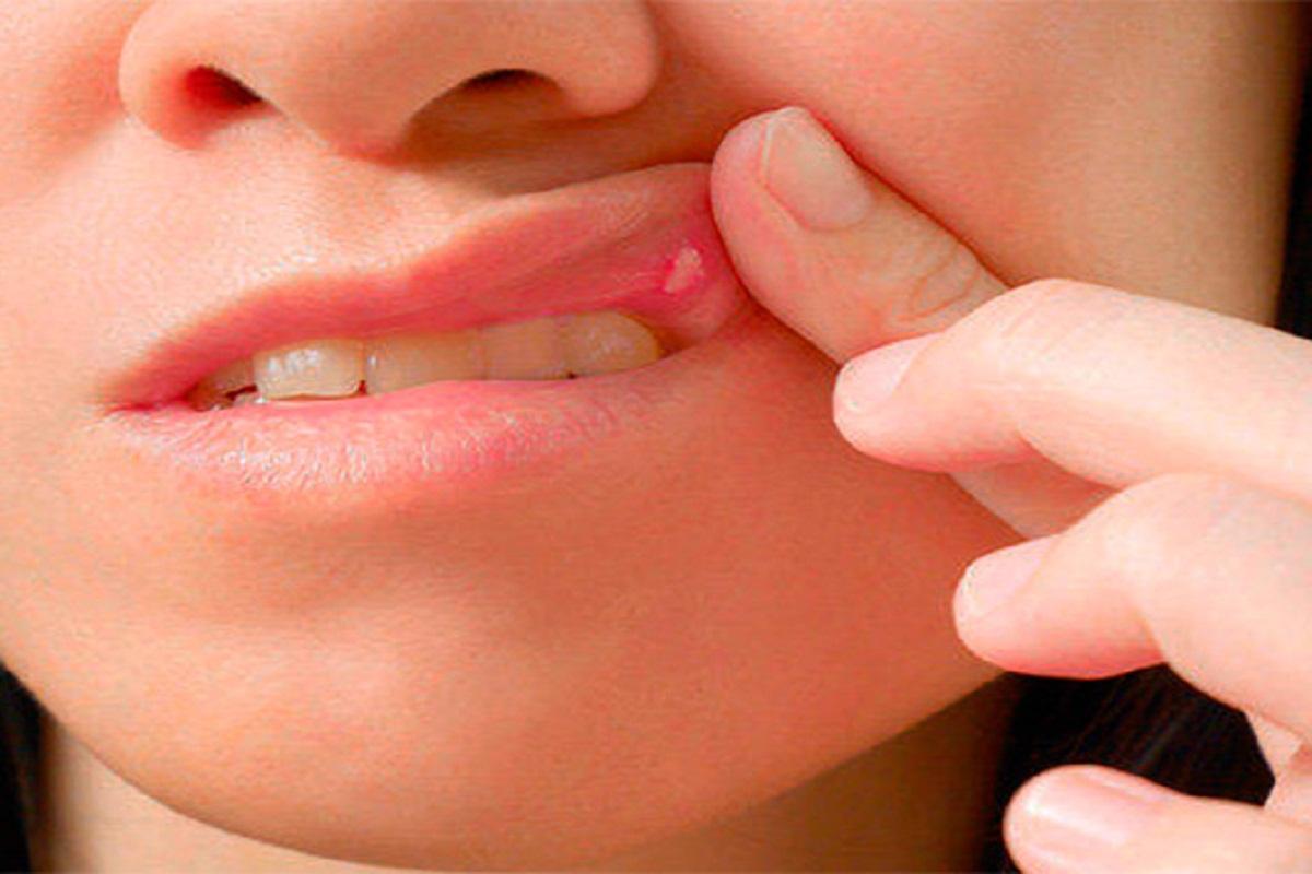 Стоматолог Мелехова указала на первые симптомы рака полости рта