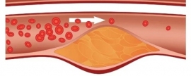 Кардиолог Жевагина описала главный источник губительного холестерина в крови