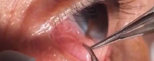 Жительница Рязани жаловалась на воспаление в глазу, а врач обнаружил там червей