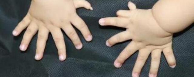 В Китае у женщины родился ребенок с 31 пальцем