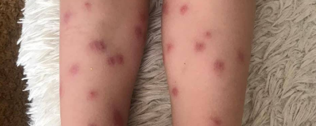 В Нижнем Новгороде в озере обнаружены черви церкарии