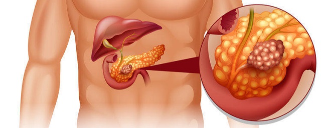 Ученые: Рост сахара в крови грозит развитием рака поджелудочной железы