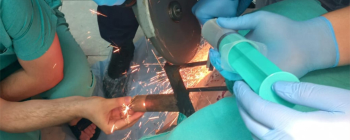 В Новосибирске хирурги спасли мужчину, которому вонзили вилы в голову