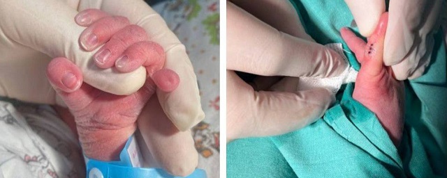 В Московском областном перинатальном центре младенцу удалили шестой палец на руке
