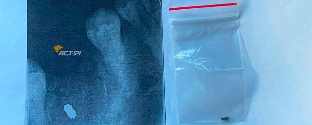 В Новосибирске стоматолог забыл кусок металла в десне пациентки