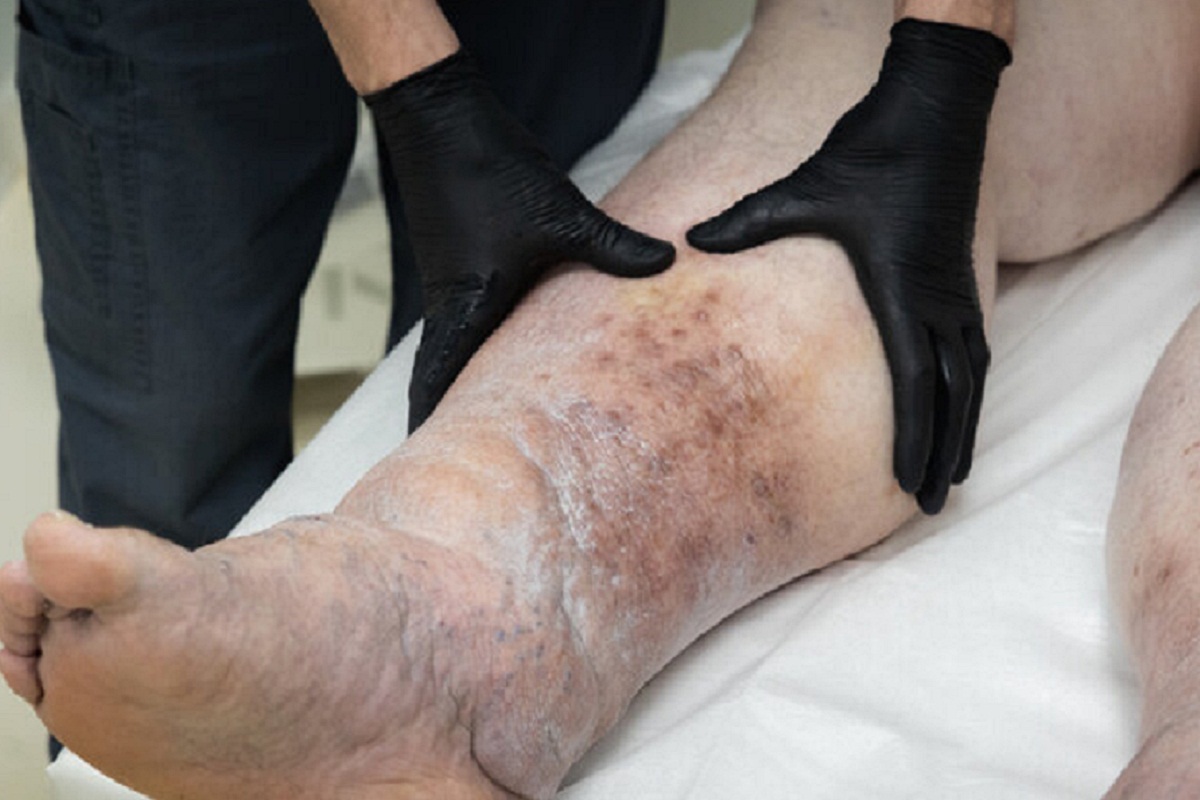 В Челябинске врачи пытаются спасти ноги мужчины с осложненным варикозом