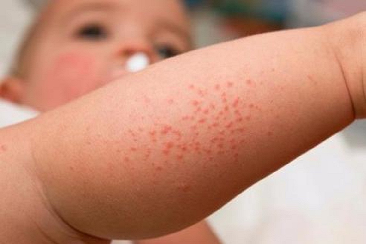 Гастроэнтеролог Яблокова объяснила, зачем давать детям аллергены