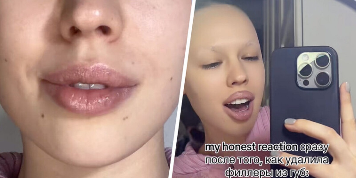 Рэперша Инстасамка сняла на видео свои губы после удаления филлеров