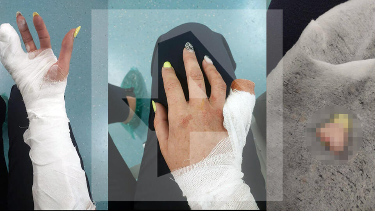 В Петербурге посетительница фитнес-клуба откусила женщине палец