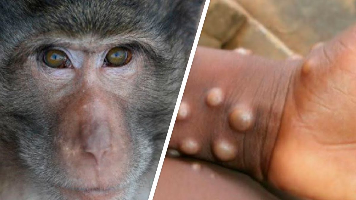 В Ирландии выявили больного оспой обезьян, заразившего этим вирусом 75 половых партнеров за 21 день