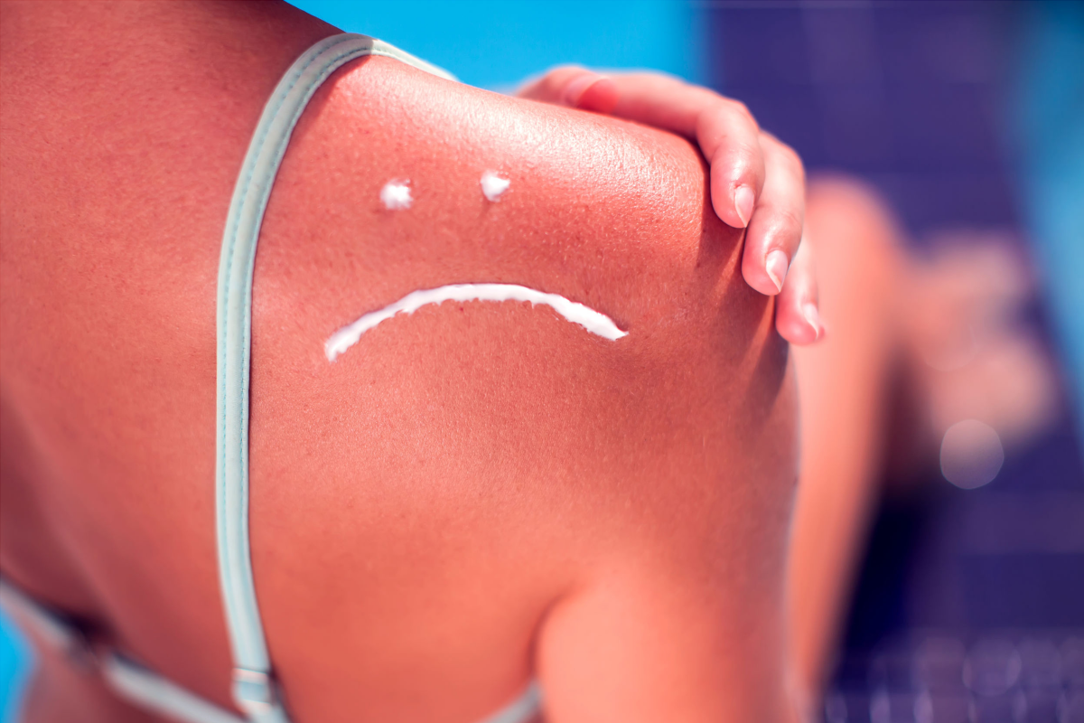 Медики рассказали, как помочь обожженной солнцем коже