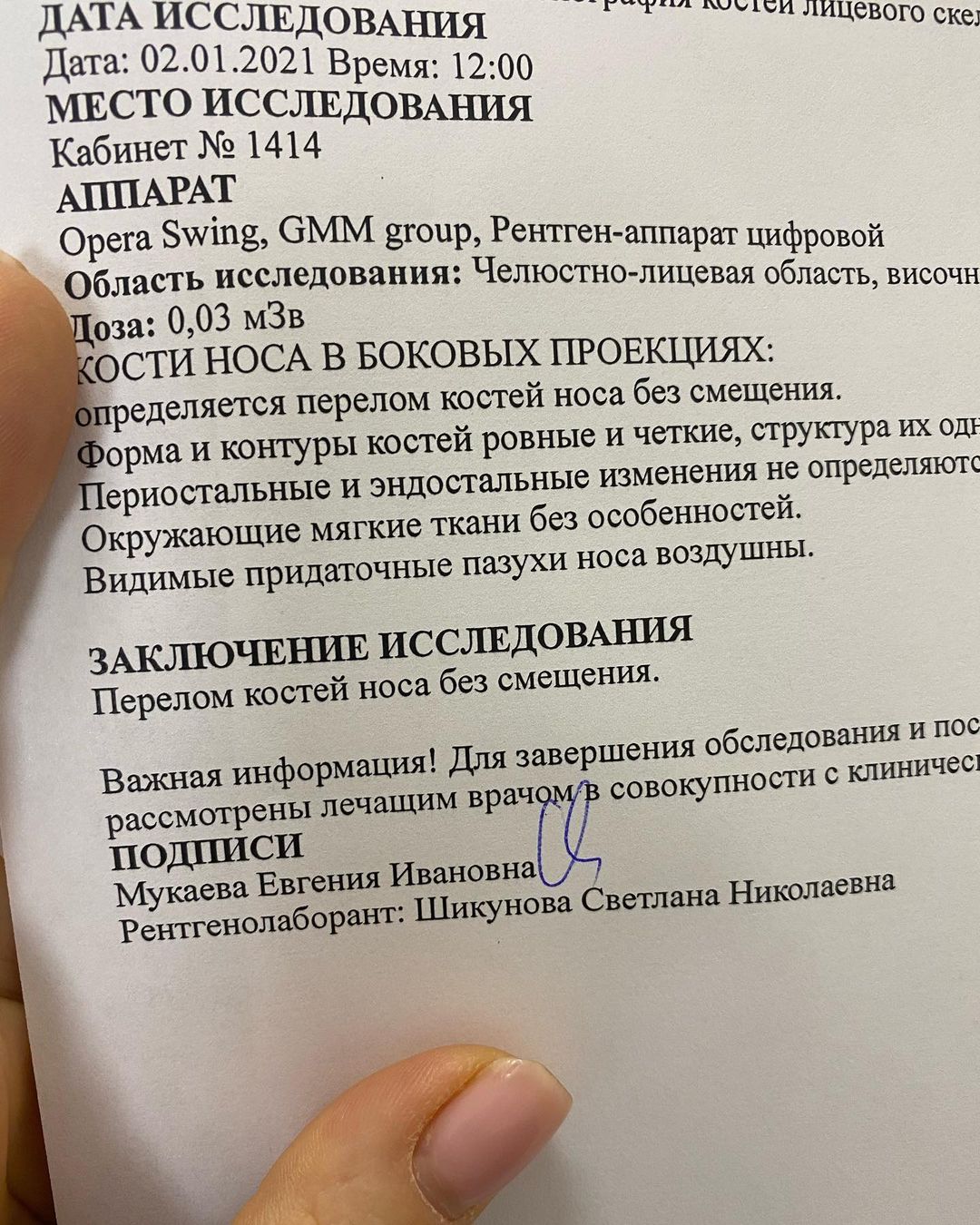 Нос актрисы Анны Хилькевич оказался сломан после новогодней ночи