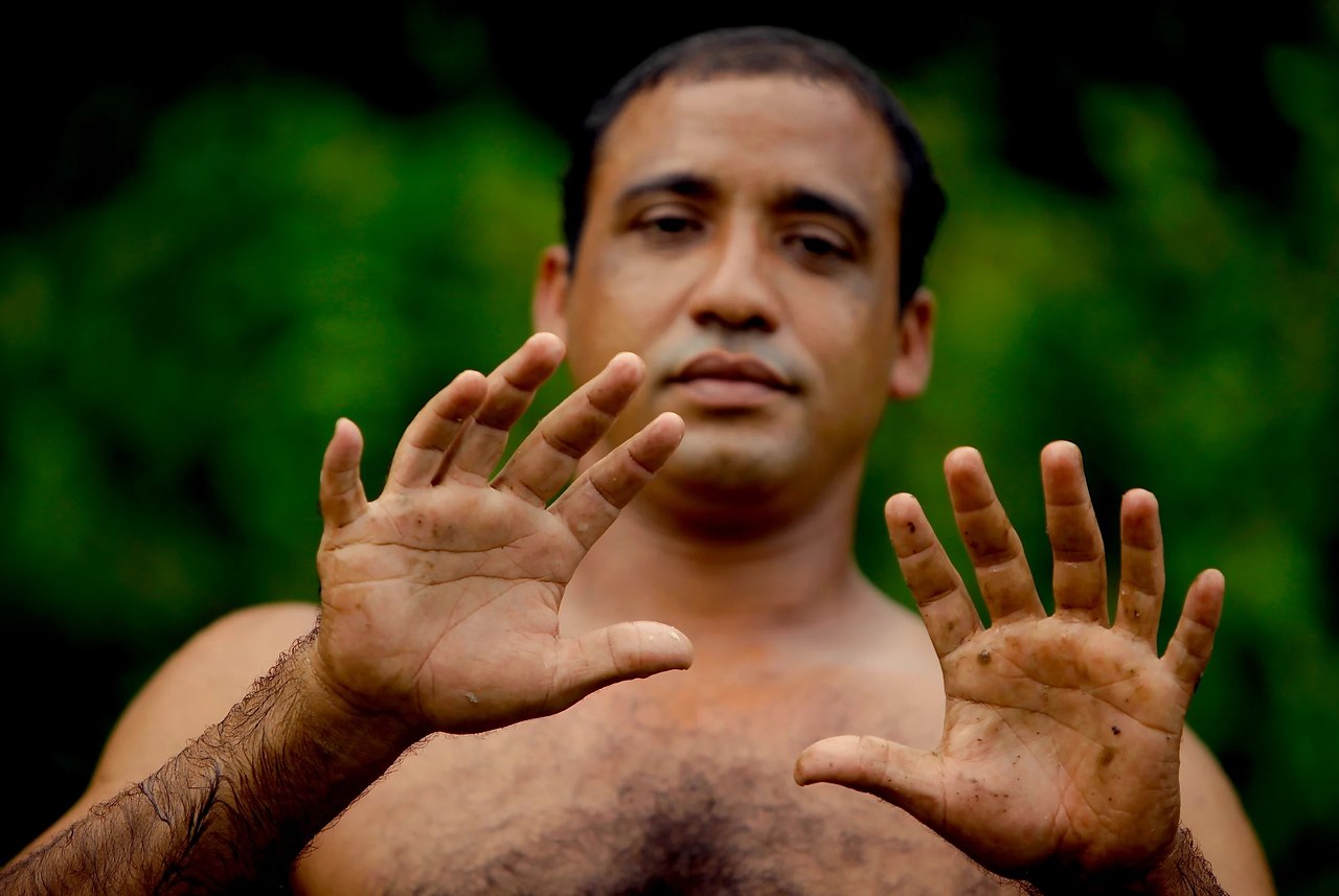 Йоандри Эрнандес Гарридо - человек с 12 пальцами на руках 