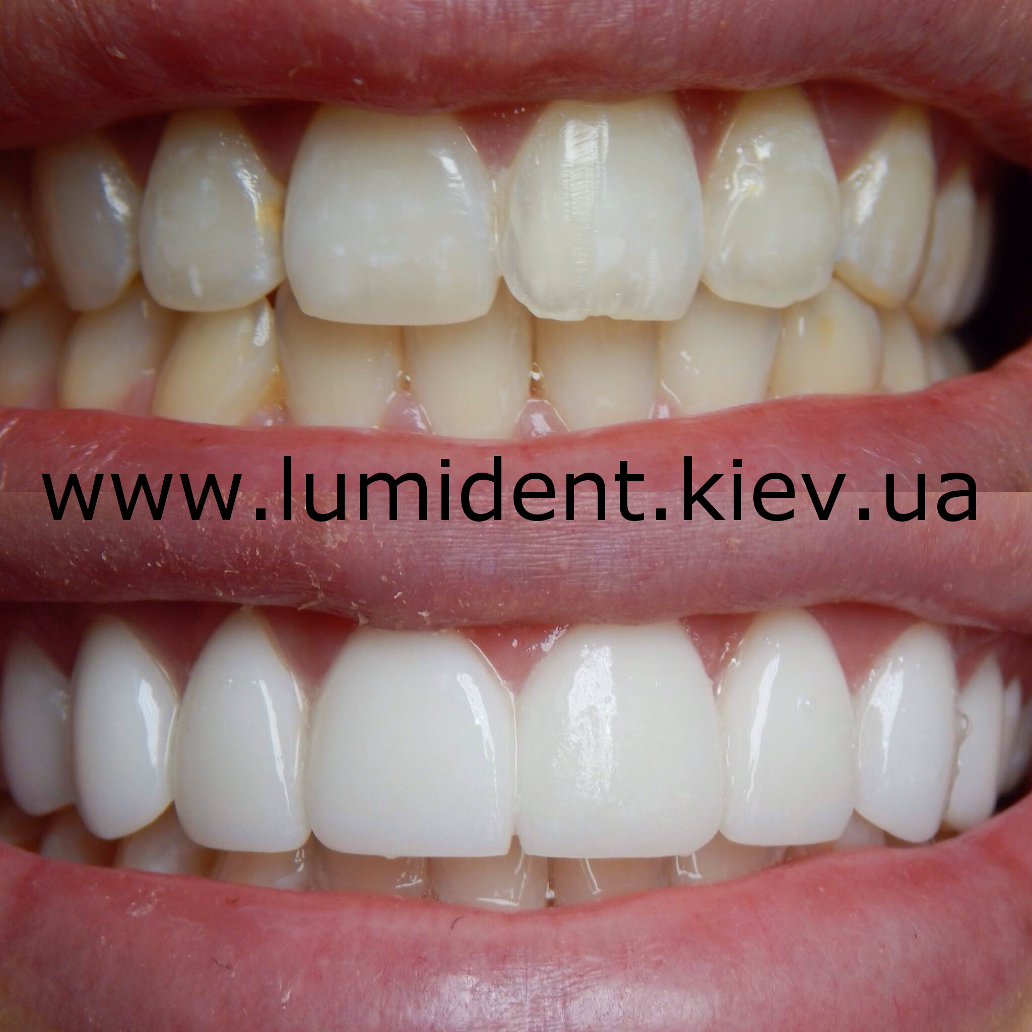 Виниры на зубах фото до и после установки