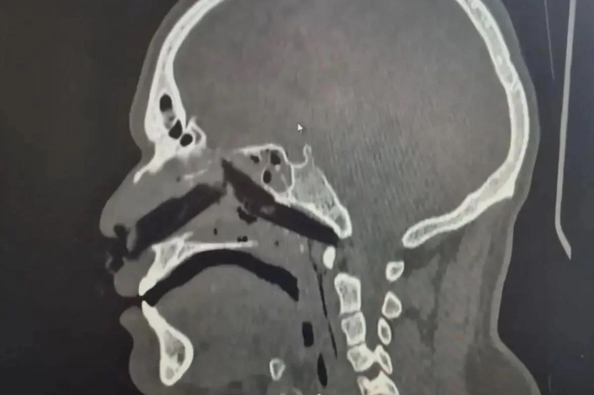 Филигранная работа хирургов: вологодские врачи удалили гигантскую щепку из носа пациента