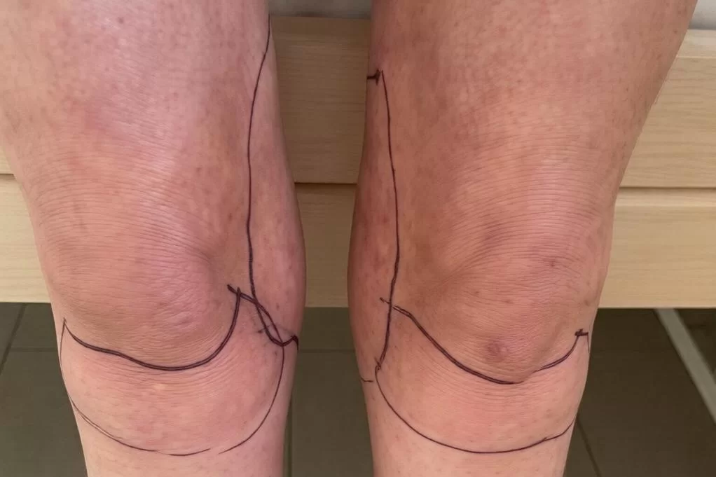 Жительнице Краснодарского края грозит ампутация ног после бьюти-процедуры